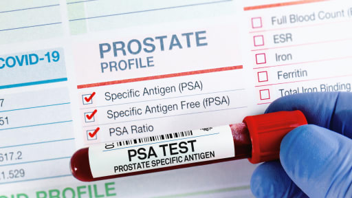 PSA-Screening: Langzeitdaten zeigen klaren Mortalitätsvorteil