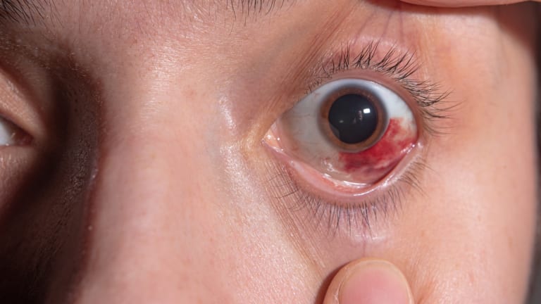 GLP1: erhöhtes Risiko für Optikusneuropathie?
