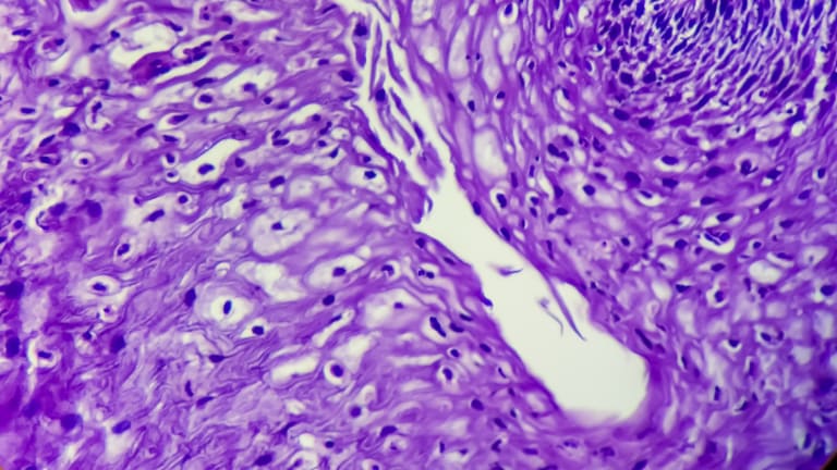 Krebs der Speiseröhre, Invasives Plattenepithelkarzinom, Grad-II, Der Tumor ist mäßig differenziert, 100x Ansicht