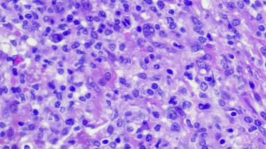 Hodgkin-Lymphom, das durch Reed-Sternberg-Zellen gekennzeichnet ist
