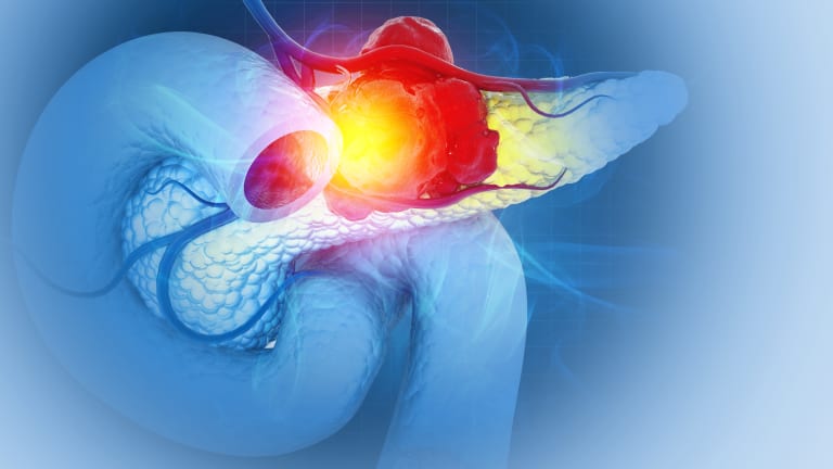 Akute Pankreatitis durch schwergradige Hypertriglyzeridämie bei karnivorer Diät