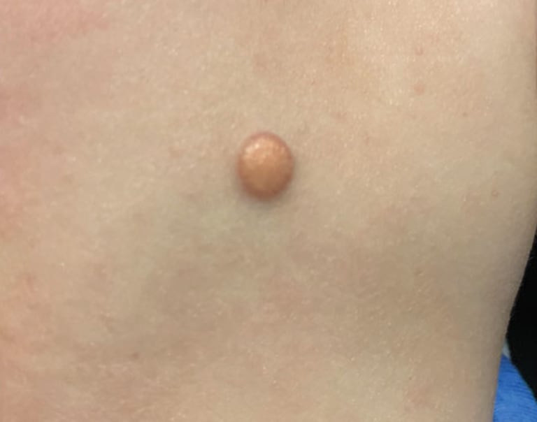 Gelbe Papel auf dem Rücken eines Säuglings Abb. 2 Gelbe Papel auf dem Rücken eines Säuglings Abb. 2