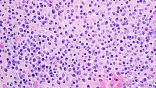 H&E-Färbung, Lichtmikroskopie, Multiples Myelom 