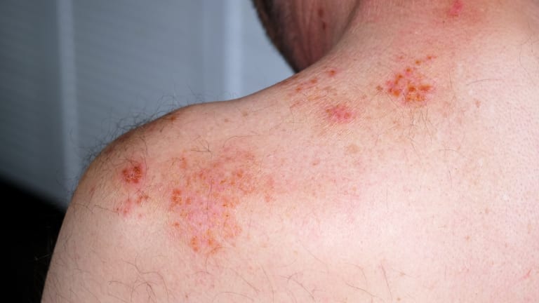 Herpes zoster 