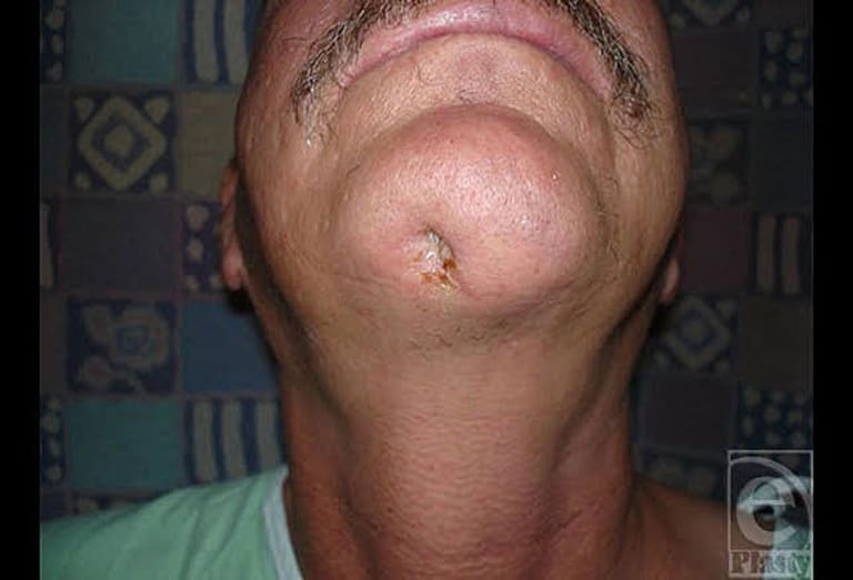 Osteomyelitis des Unterkiefers nach dem Biss einer Braunen Einsiedlerspinne