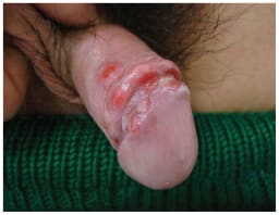 Penisgeschwüre bei einem 35-jährigen Mann