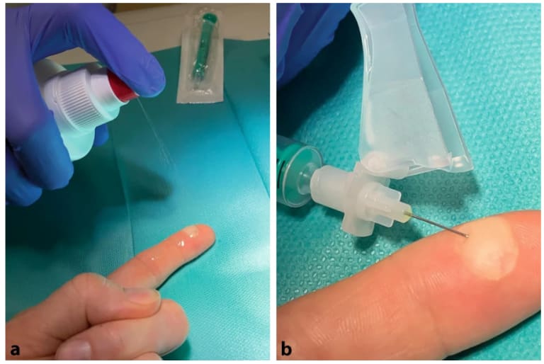 Lokaltherapeutisches Vorgehen bei Blasen