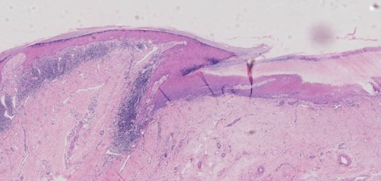 Histopathologische Veränderungen durch Lichen planus 