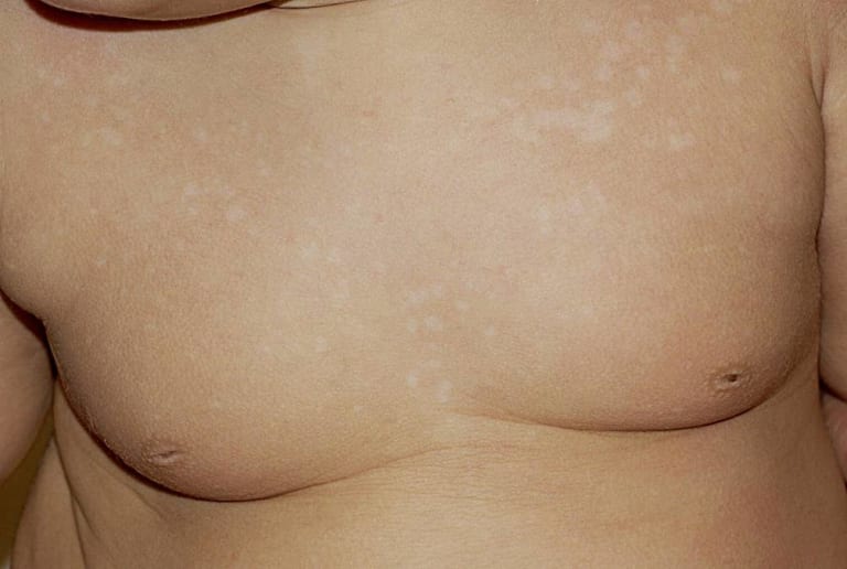 Pilzinfektionen der Haut bei Kindern