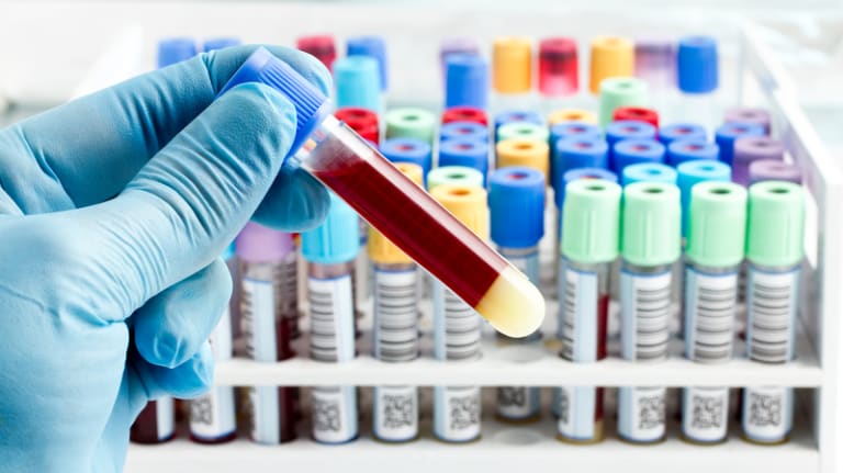 Alzheimer-Bluttests: Fortschritt mit klinischen Fallstricken
