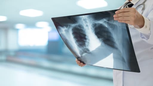 Entzündliche Erkrankungen scheinen Lungenkrebs bei Nie-Rauchern zu begünstigen 