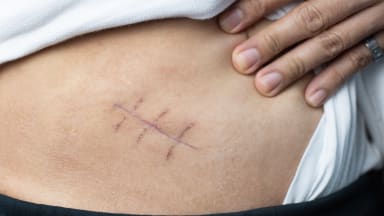 Management der akuten Appendizitis: Antibiose als OP-Alternative 