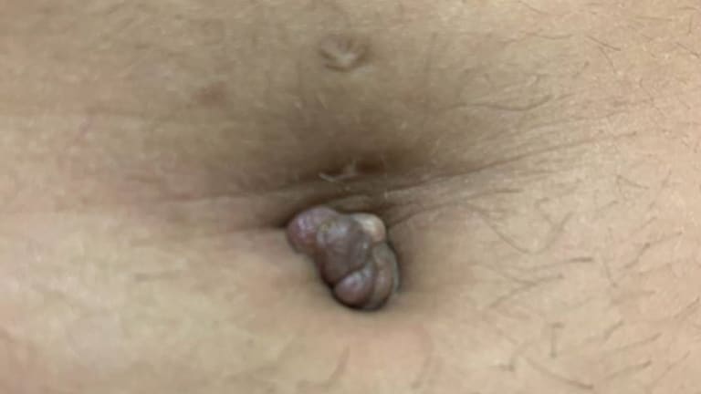 Knoten am Bauch