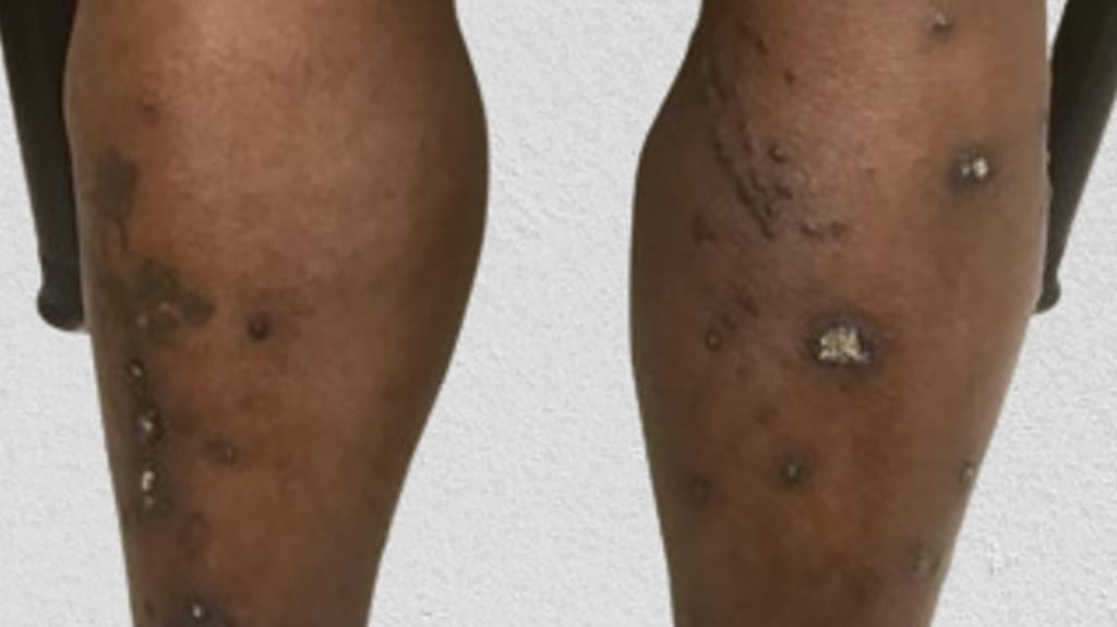 Abbildung: Patientin mit stark juckenden, harten Knötchen an den Beinen.   