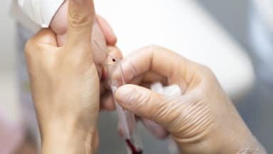 Blut abnehmen bei Neugeborenen: Mit Zuckerlösung weniger schmerzhaft