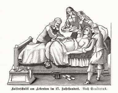 Die bewegte Geschichte des Kaiserschnitts