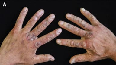 Blasen auf dunkelroten erythematösen Flecken auf dem Handrücken und den Handflächen beider Hände eines 57-jährigen Mannes