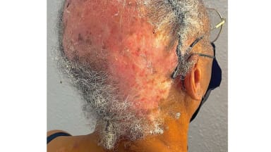 Ein extremer Fall von Lupus erythematodes 