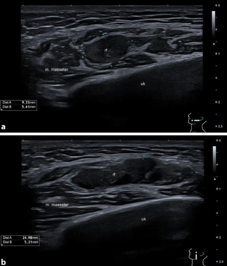B‑Bild-Sonographie des Kopfes.