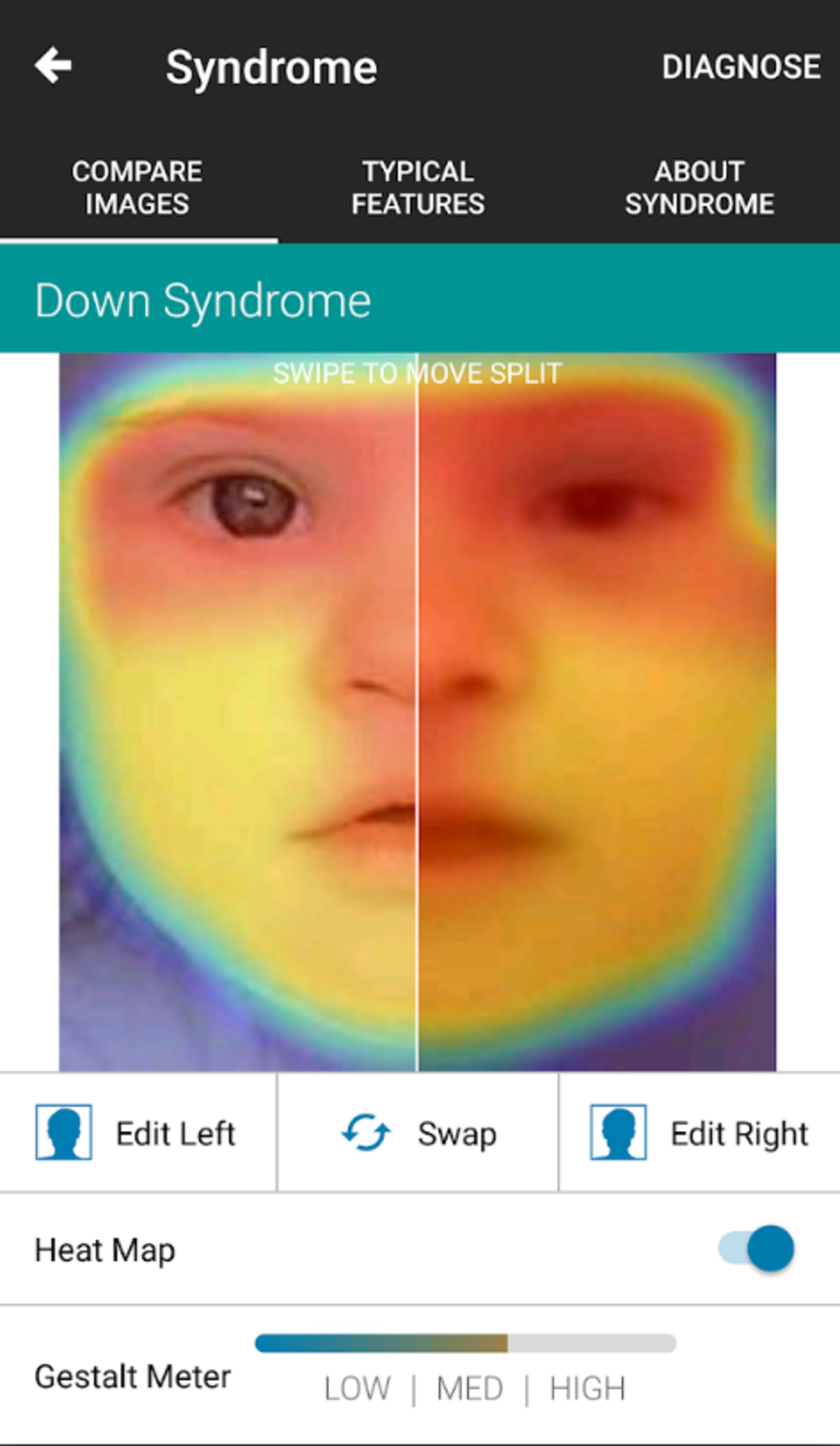 Die farblich markierten Bereiche im Gesicht sind die Stellen, anhand denen die künstliche Intelligenz das Vorliegen eines Syndroms zu erkennen glaubt. 
