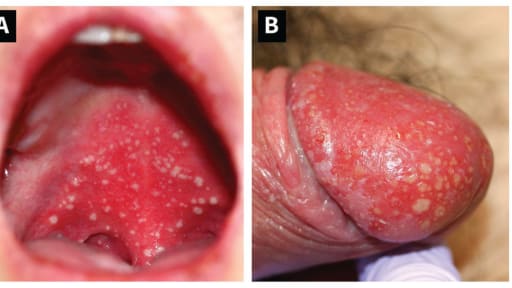 Punkte im Mund und auf Penis