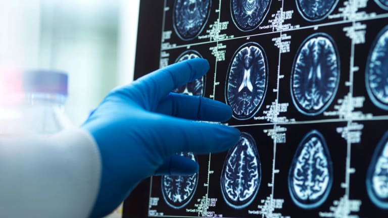 brain ct 