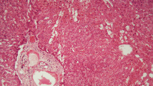 Lebergewebe mit Amyloidose unter dem Mikroskop