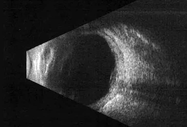 Beidseitige Papillenschwellung Abb. 4:  B‑Bild-Sonographieuntersuchung des rechten Auges