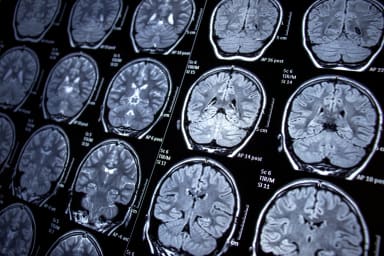 Mit Zytokinmuster plus Hirn-MRT zwischen früher Depression und Psychose unterscheiden
