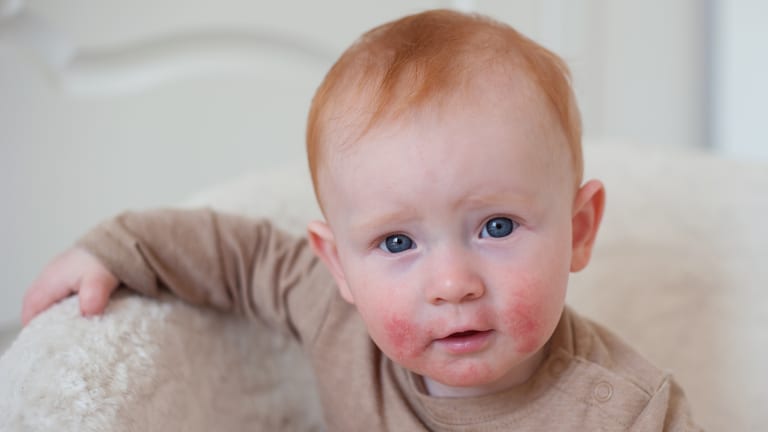 Therapieoptionen für Kinder und Jugendliche mit atopischer Dermatitis
