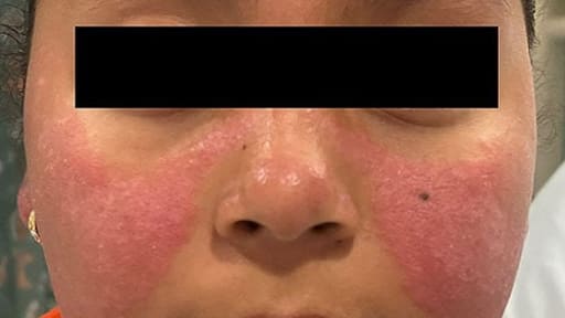 10-Jährige mit Ausschlag im Gesicht und an den Armen