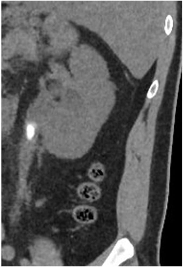 CT-Aufnahme ohne Kontrastmittel, die einen eingeklemmten Stein im mittleren linken Ureter mit schwerer linksseitiger Hydronephrose zeigt