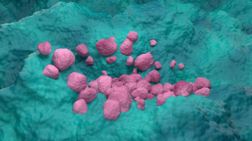 Non-small cell lung cancer (NSCLC)