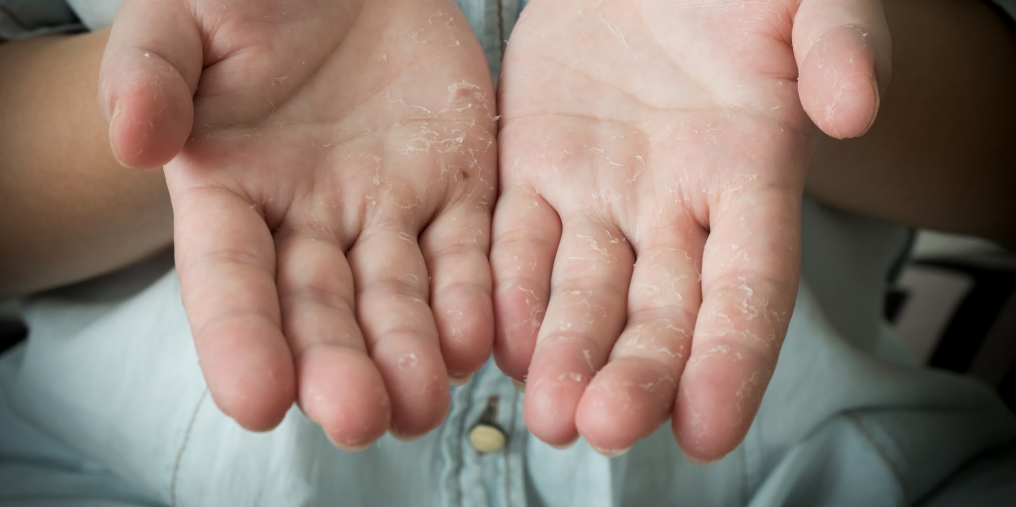 Allergietest ungengend: Standard-Test-Panels bersehen viele Allergene bei  Kontaktdermatitis