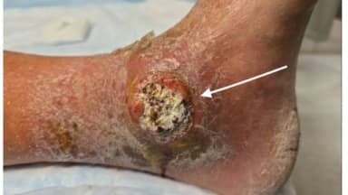 Erhabene, rundliche, ulzerierende Läsion mit kreideartigem Zentrum und umgebendem Erythem