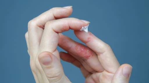 Ekzeme an den Fingern