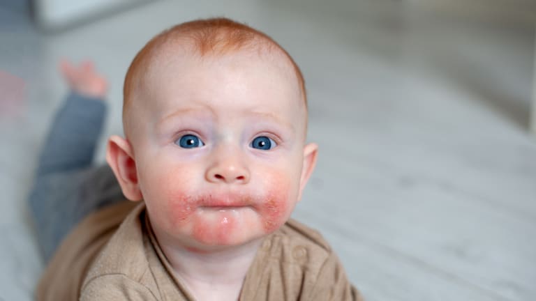 Dos und Don’ts bei kindlichen Melanomen, atopischer Dermatitis & Co