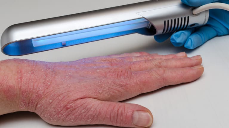 UV-Therapie neue Leitlinie