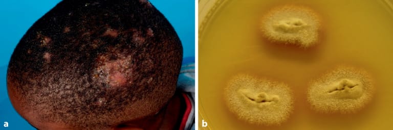 Pilzinfektionen der Haut bei Kindern